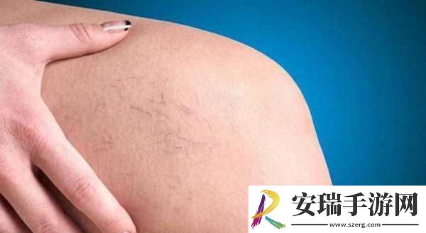 日系裸妆女士静脉曲张是什么得的
